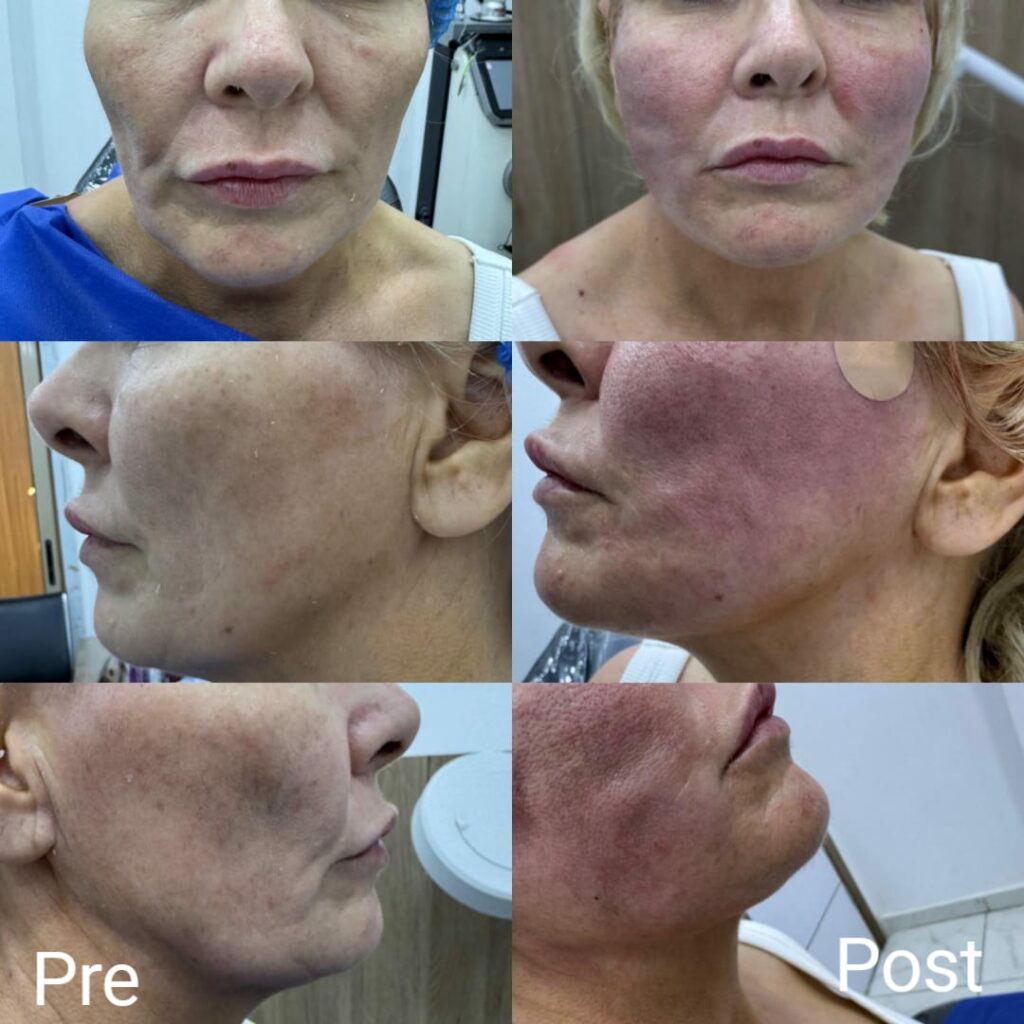 Facelift and cheek lift with cosmetic golden threads immediately after the session